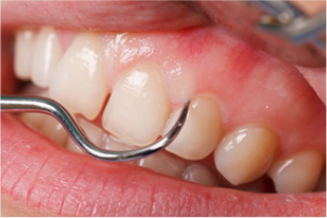 Gigi Periodonsia