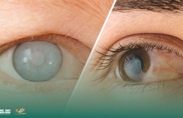 Perbedaan Glaukoma dan Katarak: Kenali Gejala dan Penanganannya