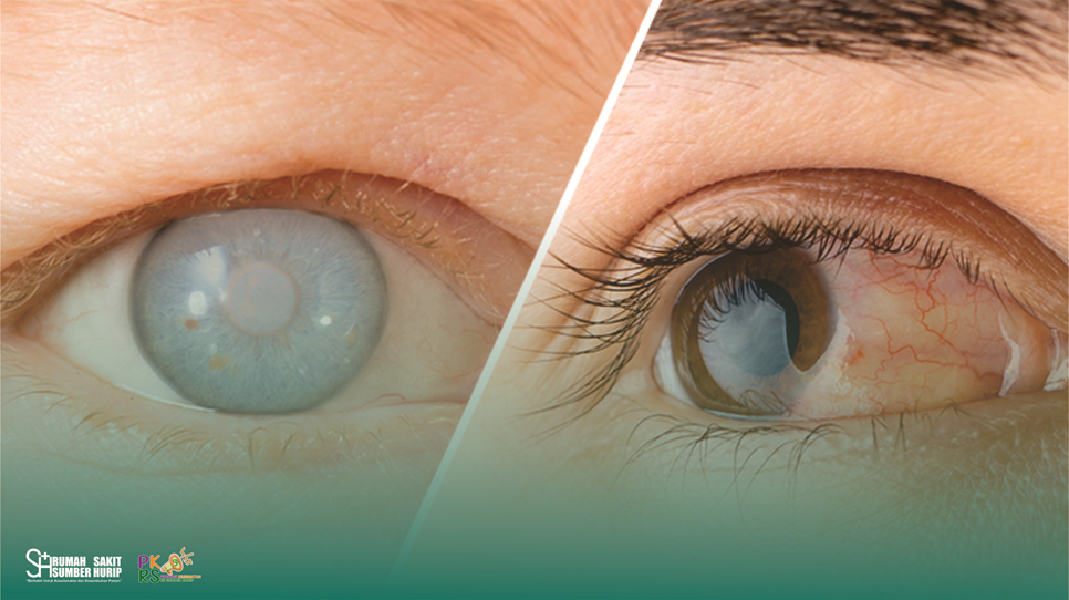 Perbedaan Glaukoma dan Katarak: Kenali Gejala dan Penanganannya