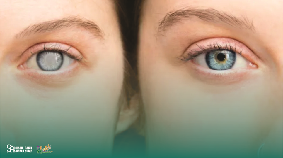 Mengenal Glaukoma sebagai Penyebab Kebutaan Permanen dan Cara Mencegahnya